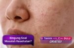 Catat, Ini Macam-Macam Bekas Jerawat dan Cara Mengatasinya