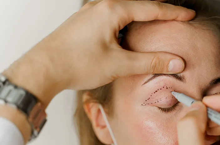 Mengenal Blepharoplasty: Mata Bebas Kendur dan Segar